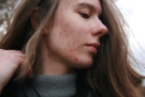 Acne Patches vs Acne Creams: Which Should You Use?